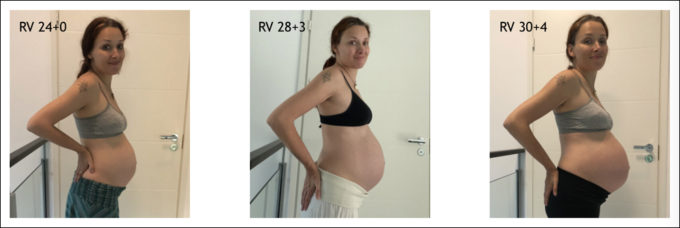 raskausmaha rv 25